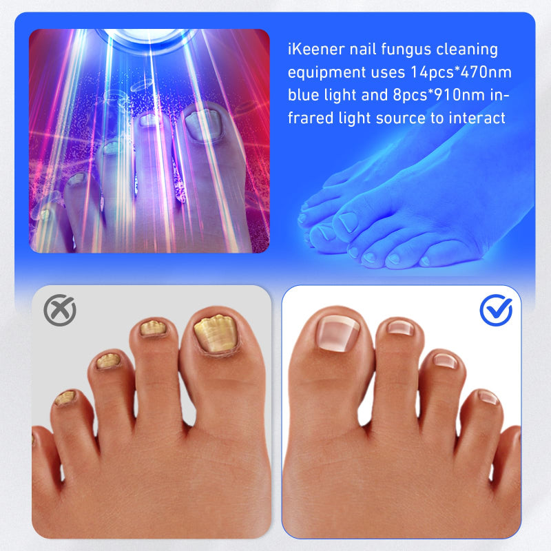 Wireless Nail Fungus Laser